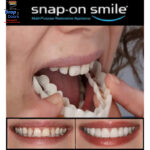 Pack Of 2 Pairs Snap-On Smile Custom Fit Perfect Smile Veneers In 3 Easy Steps