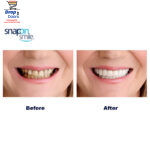 Pack Of 2 Pairs Snap-On Smile Custom Fit Perfect Smile Veneers In 3 Easy Steps